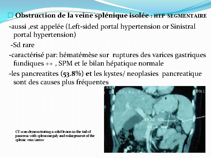 � Obstruction de la veine splénique isolée : HTP SEGMENTAIRE -aussi , est appelée