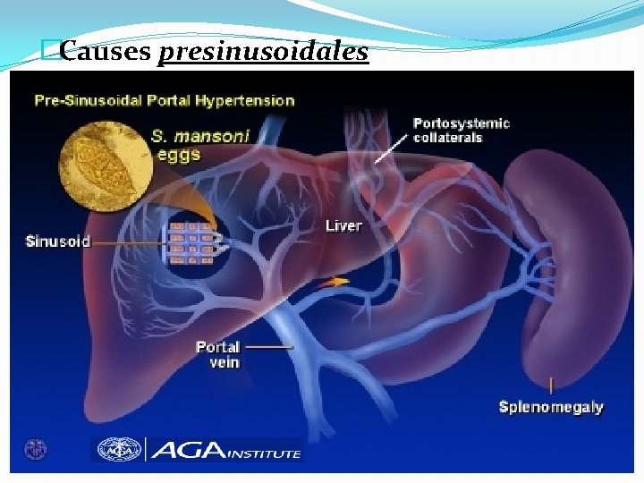 �Causes presinusoidales 