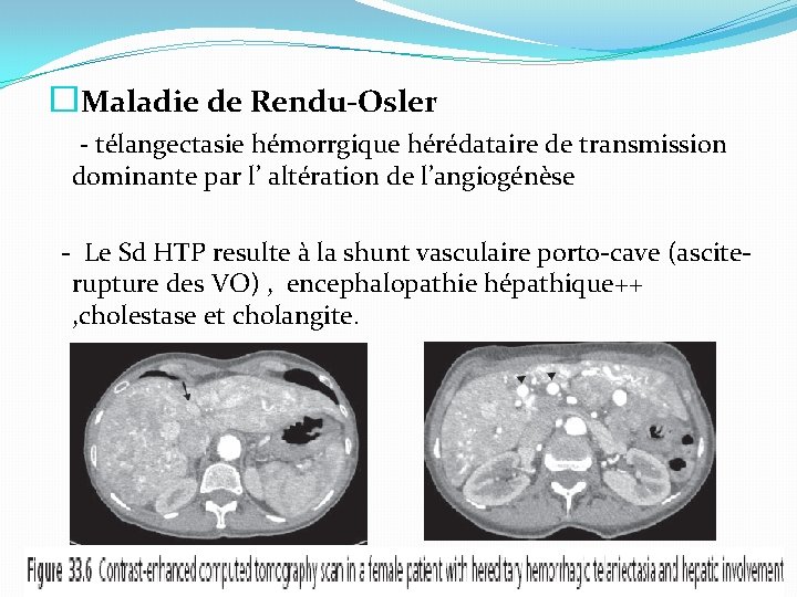 �Maladie de Rendu-Osler - télangectasie hémorrgique hérédataire de transmission dominante par l’ altération de