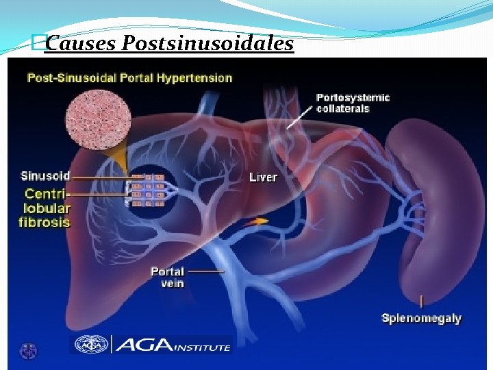 �Causes Postsinusoidales 