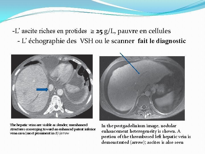 -L’ ascite riches en protides ≥ 25 g/L, pauvre en cellules - L’ échographie