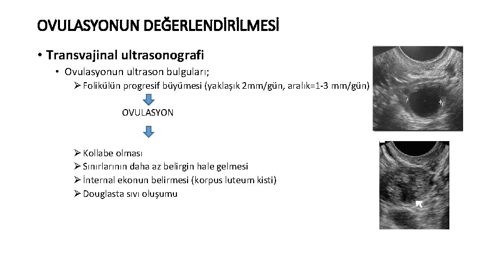 OVULASYONUN DEĞERLENDİRİLMESİ • Transvajinal ultrasonografi • Ovulasyonun ultrason bulguları; Ø Folikülün progresif büyümesi (yaklaşık