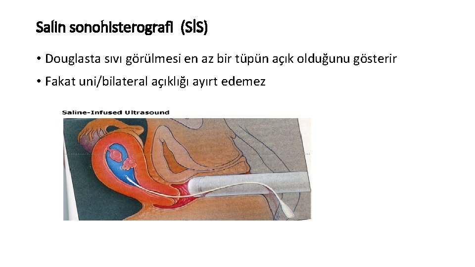 Salin sonohisterografi (SİS) • Douglasta sıvı görülmesi en az bir tüpün açık olduğunu gösterir