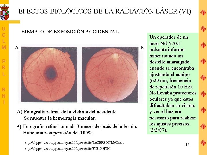 EFECTOS BIOLÓGICOS DE LA RADIACIÓN LÁSER (VI) EJEMPLO DE EXPOSICIÓN ACCIDENTAL A B A)