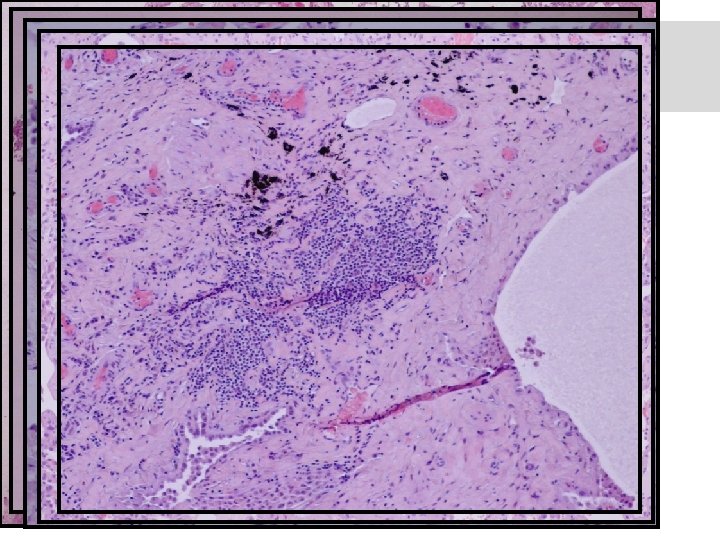 Surgical lung biopsy 