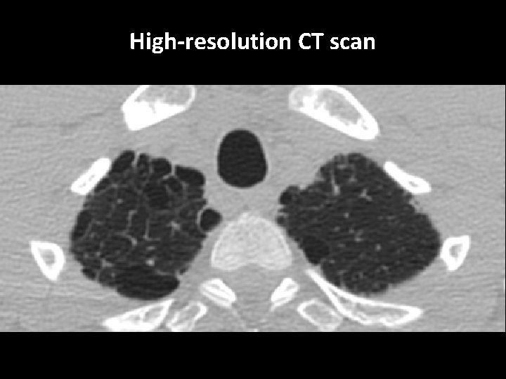 High-resolution CT scan 