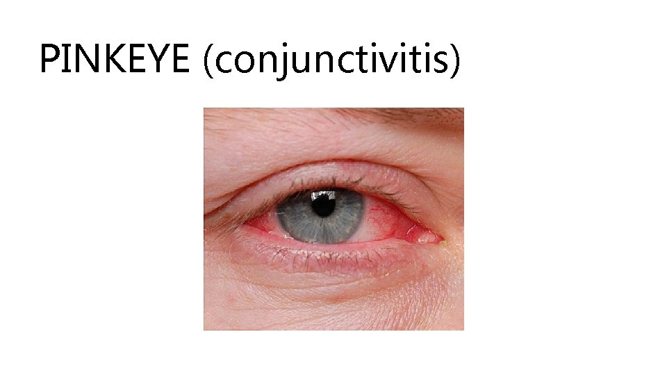 PINKEYE (conjunctivitis) 