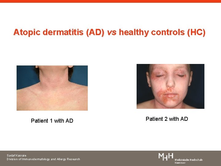 Atopic dermatitis (AD) vs healthy controls (HC) Patient 1 with AD Sadaf Kasraie Division