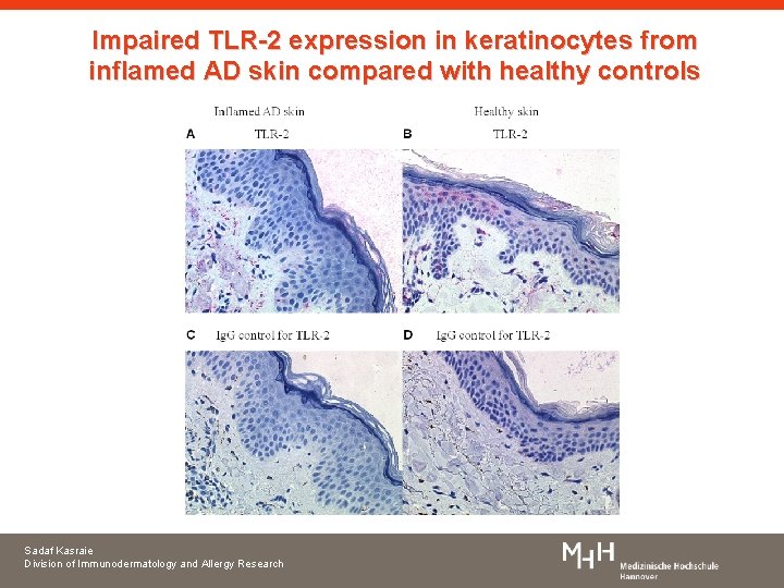 Impaired TLR-2 expression in keratinocytes from inflamed AD skin compared with healthy controls Sadaf