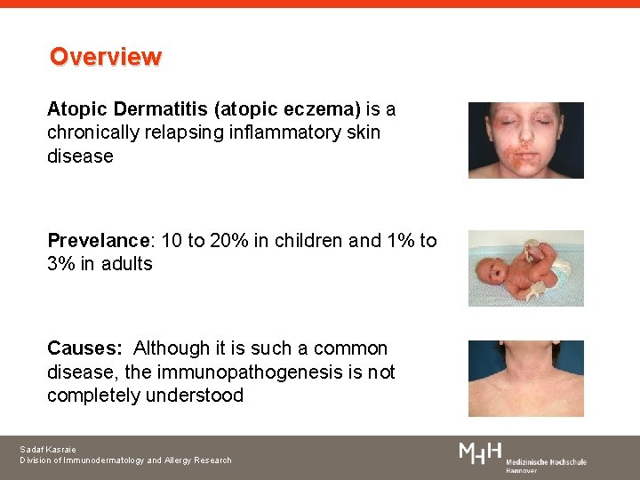 Overview Atopic Dermatitis (atopic eczema) is a chronically relapsing inflammatory skin disease Prevelance: 10