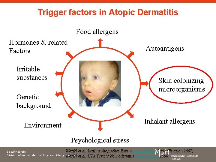 Trigger factors in Atopic Dermatitis Food allergens Hormones & related Factors Autoantigens Irritable substances