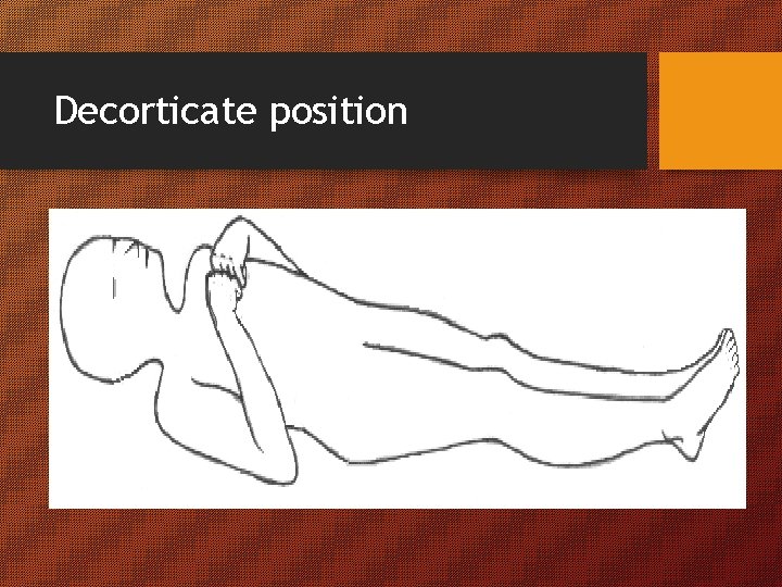 Decorticate position Decorticate position