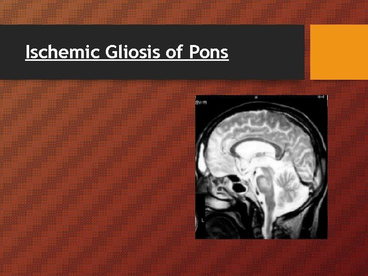 Ischemic Gliosis of Pons Ischemic Gliosis of Pons