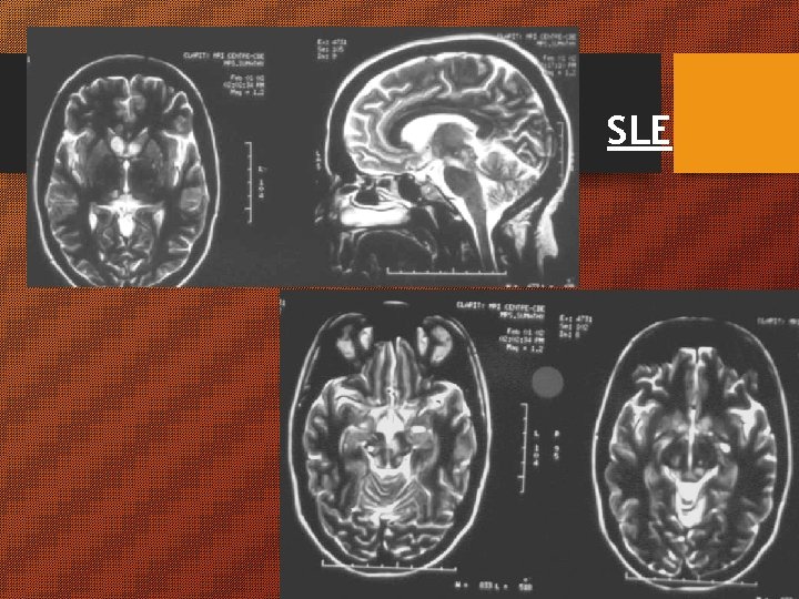 SLE SLE