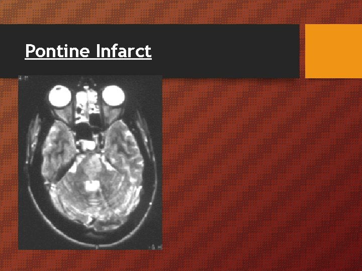 Pontine Infarct Pontine Infarct