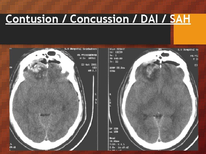 Contusion / Concussion / DAI / SAH Contusion / Concussion / DAI / SAH