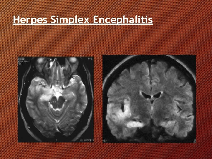 Herpes Simplex Encephalitis Herpes Simplex Encephalitis
