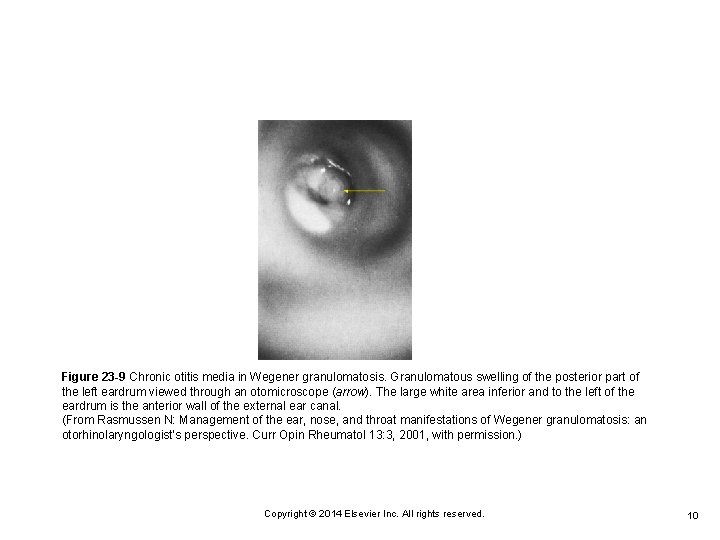 Figure 23 -9 Chronic otitis media in Wegener granulomatosis. Granulomatous swelling of the posterior