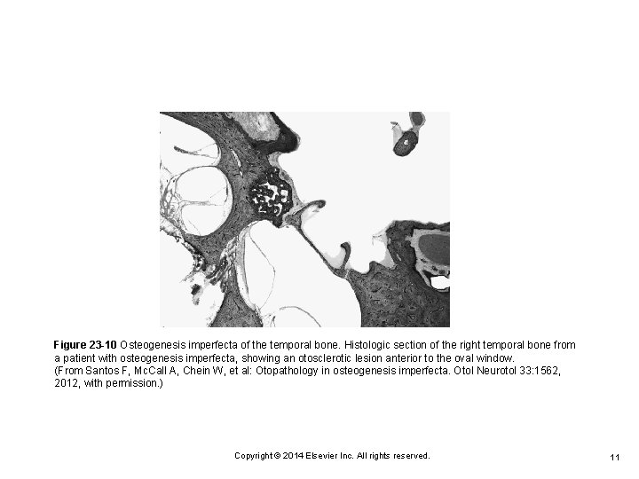 Figure 23 -10 Osteogenesis imperfecta of the temporal bone. Histologic section of the right