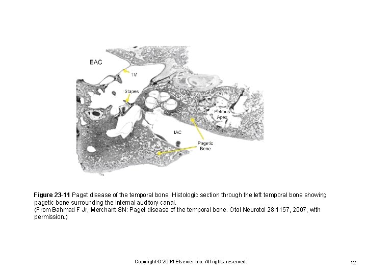 Figure 23 -11 Paget disease of the temporal bone. Histologic section through the left