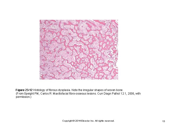 Figure 23 -12 Histology of fibrous dysplasia. Note the irregular shapes of woven bone.