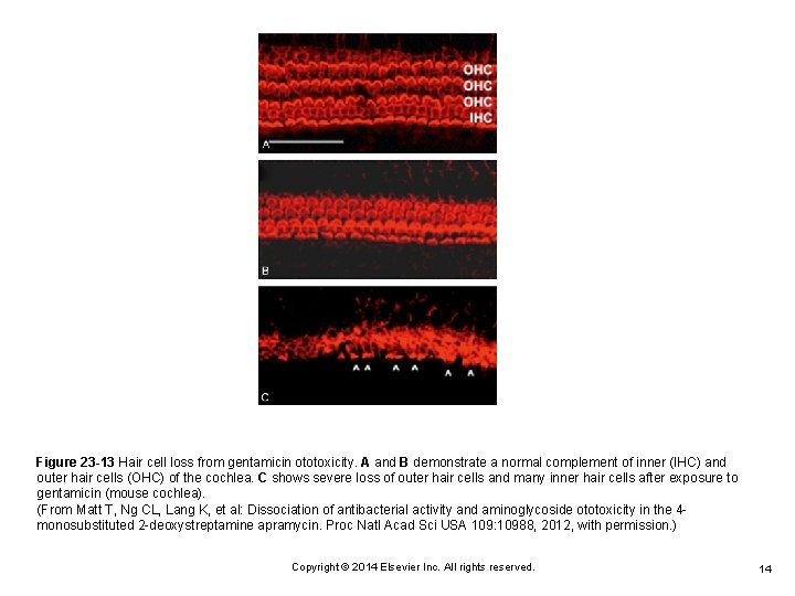 Figure 23 -13 Hair cell loss from gentamicin ototoxicity. A and B demonstrate a