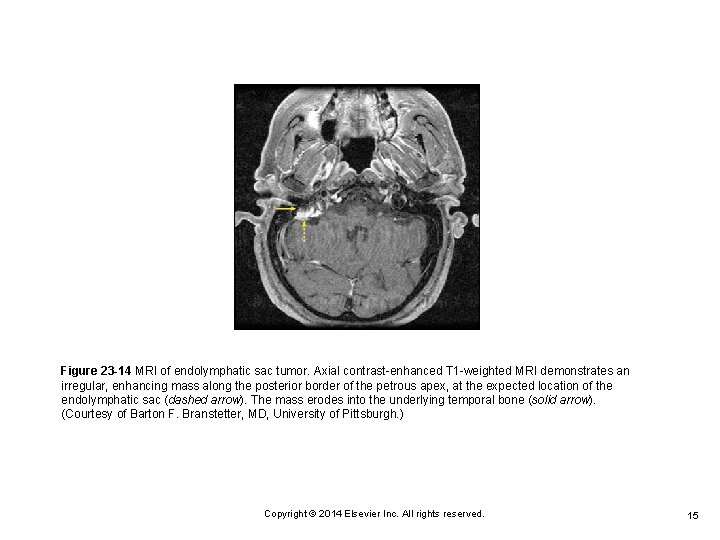 Figure 23 -14 MRI of endolymphatic sac tumor. Axial contrast-enhanced T 1 -weighted MRI
