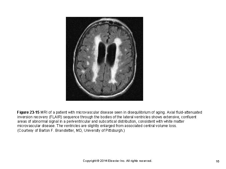 Figure 23 -15 MRI of a patient with microvascular disease seen in disequilibrium of