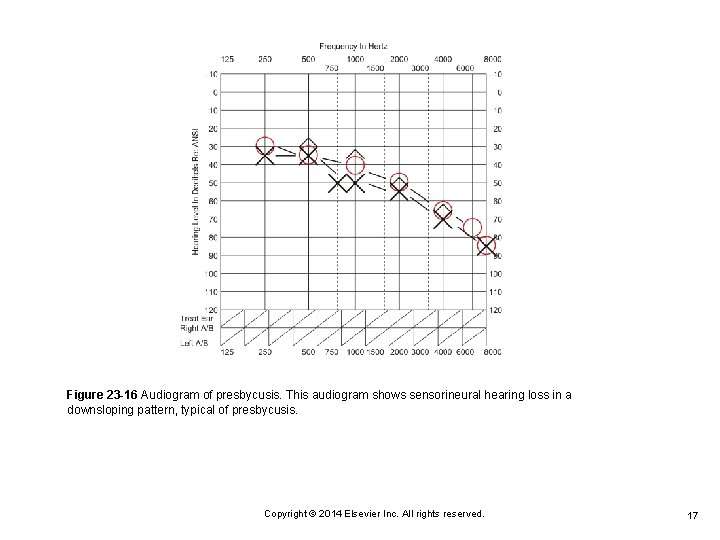 Figure 23 -16 Audiogram of presbycusis. This audiogram shows sensorineural hearing loss in a