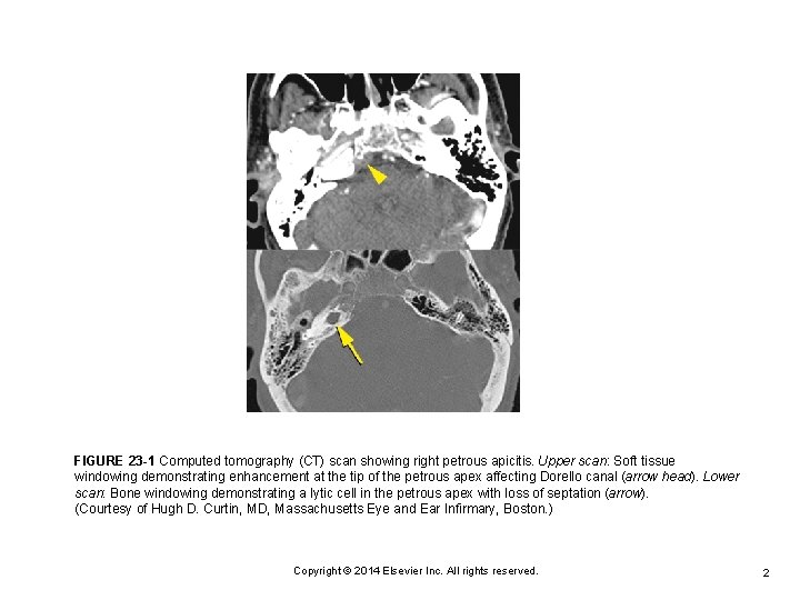 FIGURE 23 -1 Computed tomography (CT) scan showing right petrous apicitis. Upper scan: Soft