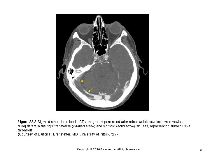 Figure 23 -2 Sigmoid sinus thrombosis. CT venography performed after retromastoid craniectomy reveals a