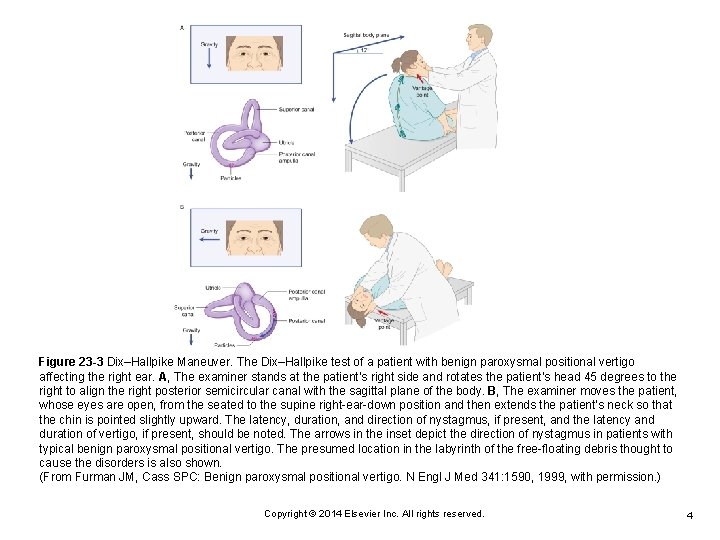 Figure 23 -3 Dix–Hallpike Maneuver. The Dix–Hallpike test of a patient with benign paroxysmal