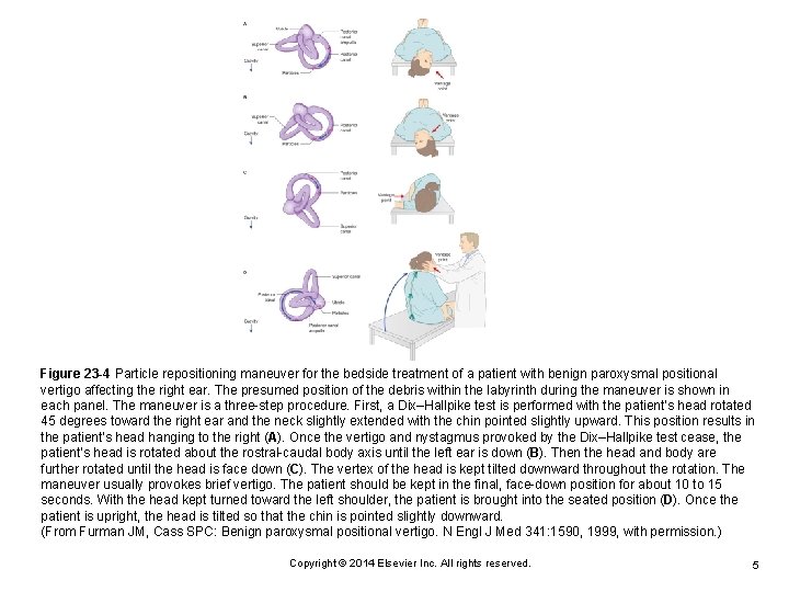 Figure 23 -4 Particle repositioning maneuver for the bedside treatment of a patient with