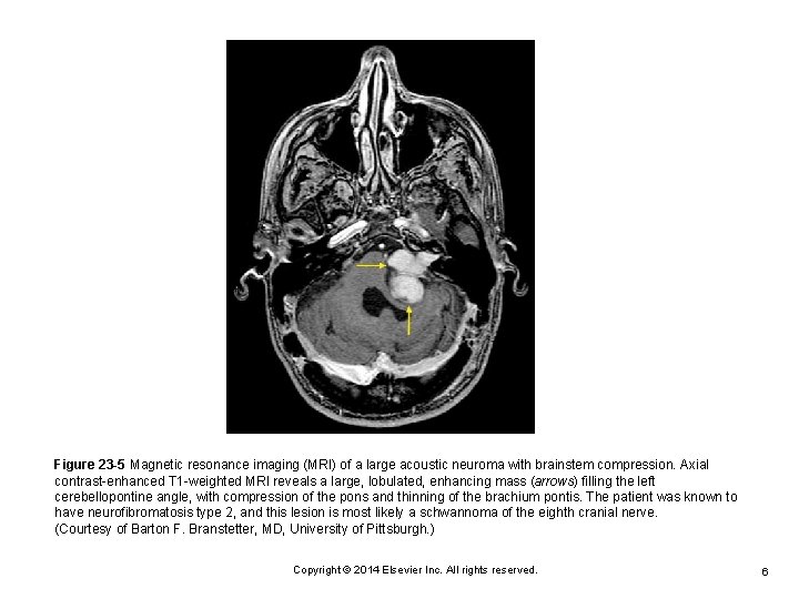 Figure 23 -5 Magnetic resonance imaging (MRI) of a large acoustic neuroma with brainstem