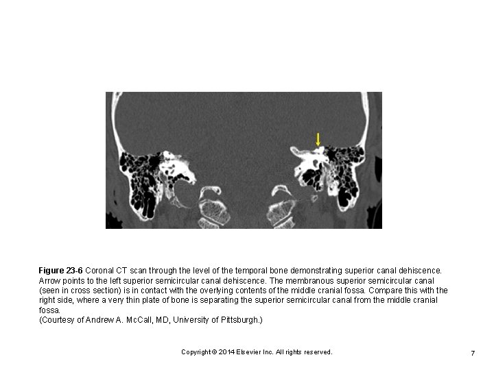 Figure 23 -6 Coronal CT scan through the level of the temporal bone demonstrating