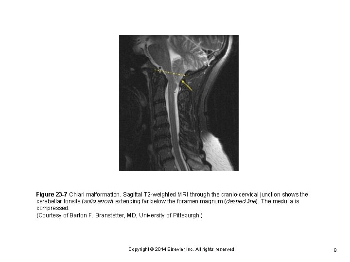 Figure 23 -7 Chiari malformation. Sagittal T 2 -weighted MRI through the cranio-cervical junction