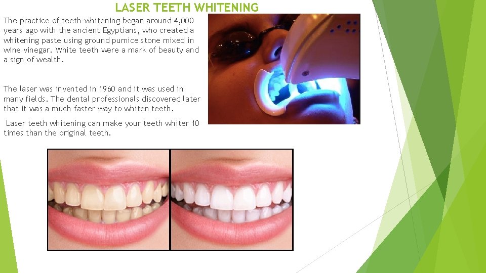 LASER TEETH WHITENING The practice of teeth-whitening began around 4, 000 years ago with