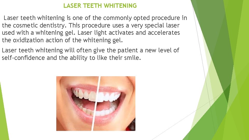 LASER TEETH WHITENING Laser teeth whitening is one of the commonly opted procedure in