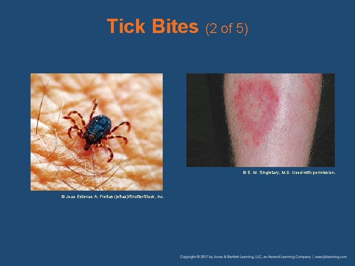 Tick Bites (2 of 5) © E. M. Singletary, M. D. Used with permission.