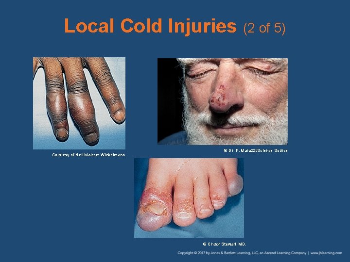 Local Cold Injuries (2 of 5) Courtesy of Neil Malcom Winkelmann © Dr. P.