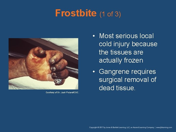 Frostbite (1 of 3) • Most serious local cold injury because the tissues are