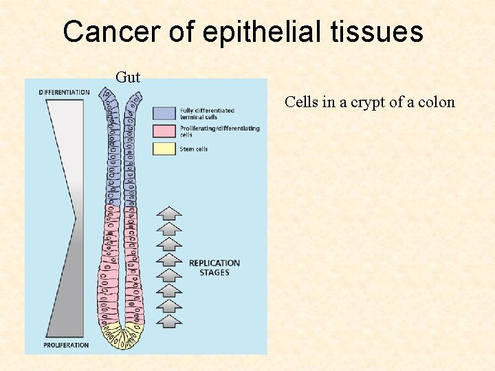 Cancer of epithelial tissues Gut Cells in a crypt of a colon 