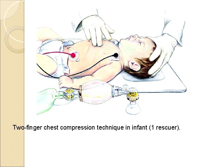 Two-finger chest compression technique in infant (1 rescuer). 