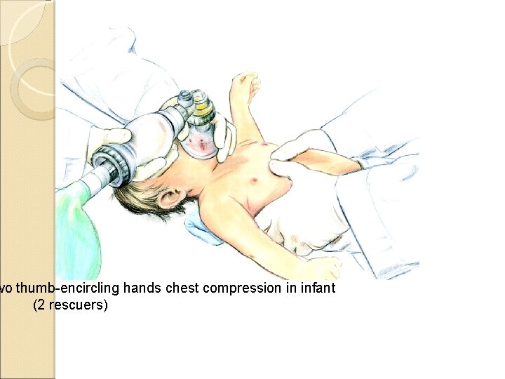 wo thumb-encircling hands chest compression in infant (2 rescuers) 