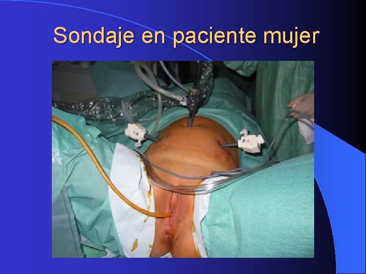 Sondaje en paciente mujer Sondaje en paciente mujer