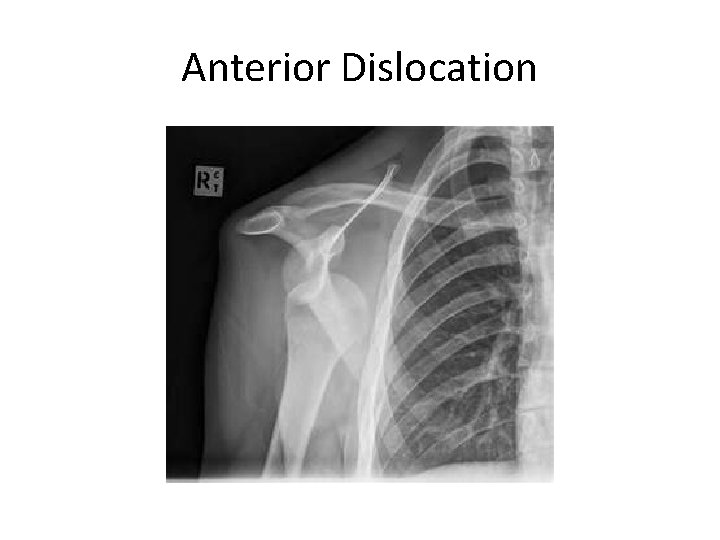 Anterior Dislocation 