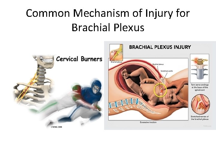 Common Mechanism of Injury for Brachial Plexus 