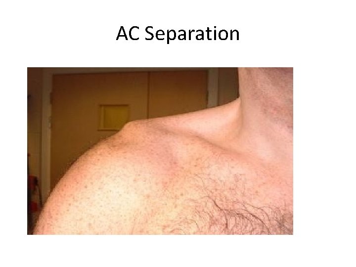 AC Separation 