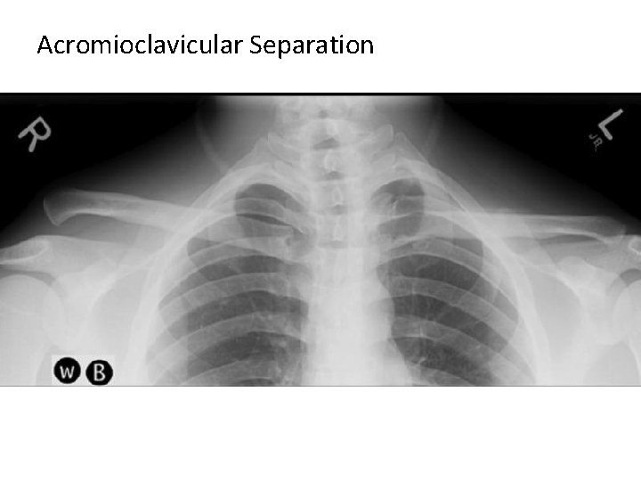 Acromioclavicular Separation 
