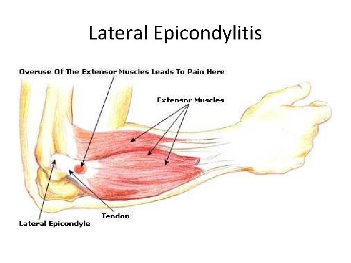 Lateral Epicondylitis 